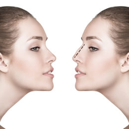 Nase einer Frau vor und nach einer Schönheitsoperation