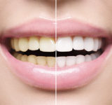 Zähne im Vergleich vor und nach Bleaching